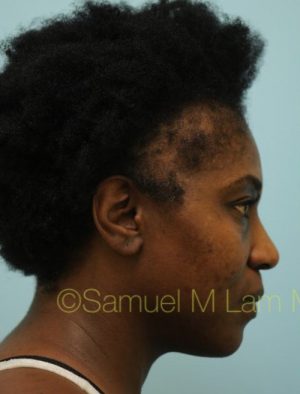 African Hair Transplant