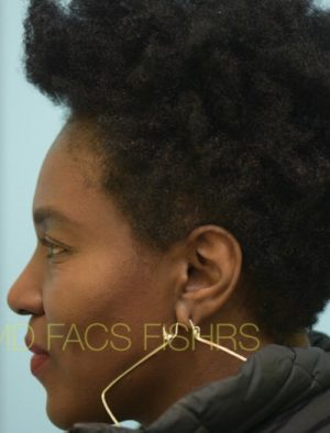 African Hair Transplant