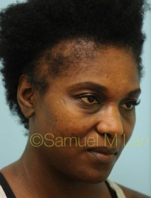 African Hair Transplant
