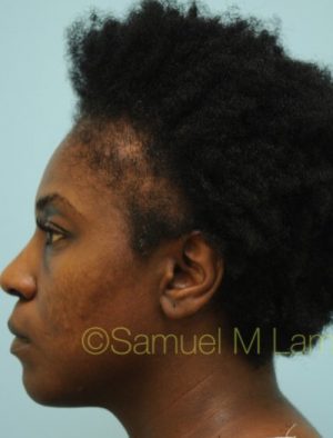 African Hair Transplant