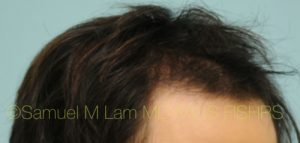 PRP Injections