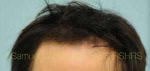 PRP Injections