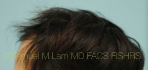 PRP Injections