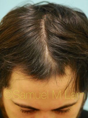 PRP Injections