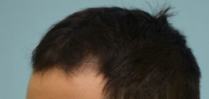 PRP Injections
