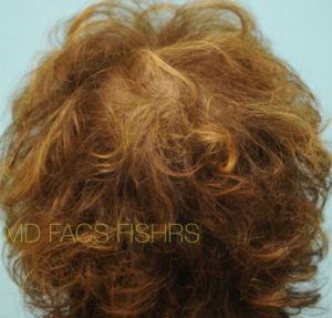 Female Hair Transplant