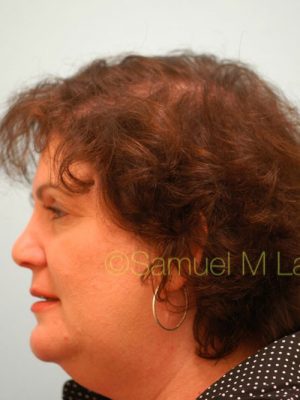 Female Hair Transplant