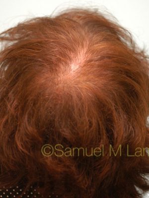 Female Hair Transplant