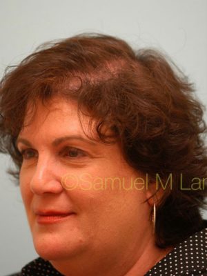 Female Hair Transplant
