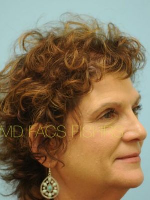 Female Hair Transplant