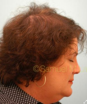 Female Hair Transplant