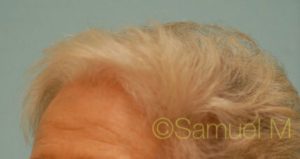 Female Hair Transplant