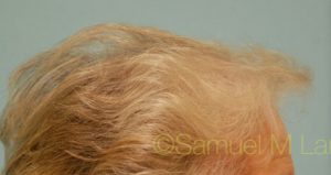 Female Hair Transplant
