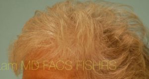 Female Hair Transplant