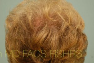 Female Hair Transplant