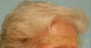 Female Hair Transplant