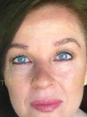 Eyebrow Hair Restoration