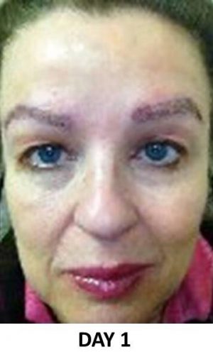 Eyebrow Hair Restoration