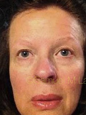 Eyebrow Hair Restoration