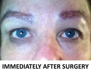 Eyebrow Hair Restoration