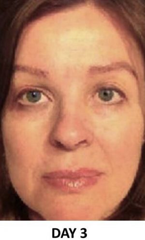 Eyebrow Hair Restoration