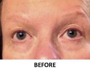 Eyebrow Hair Restoration