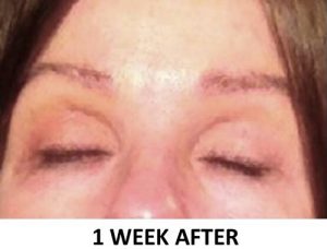 Eyebrow Hair Restoration