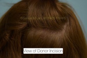 Eyebrow Hair Restoration