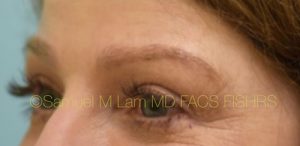 Eyebrow Hair Restoration