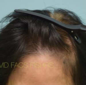 Female Hair Restoration
