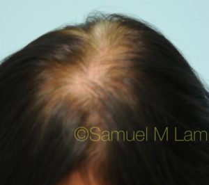Female Hair Restoration