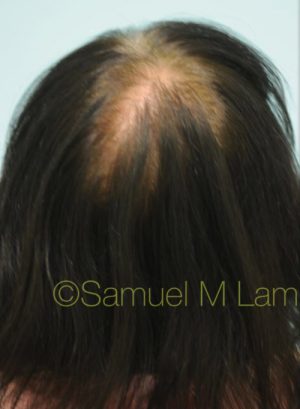 Female Hair Restoration