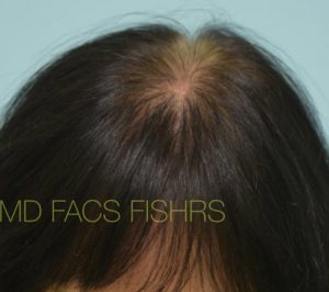 Female Hair Restoration