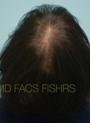 Female Hair Restoration