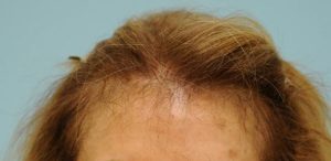 Female Hair Restoration