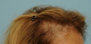 Female Hair Restoration