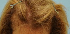 Female Hair Restoration