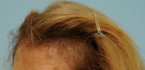 Female Hair Restoration