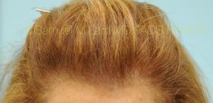 Female Hair Restoration