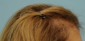 Female Hair Restoration