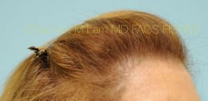 Female Hair Restoration