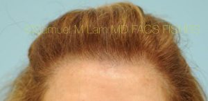 Female Hair Restoration
