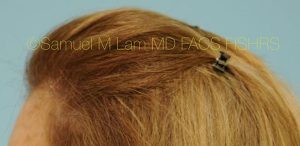 Female Hair Restoration