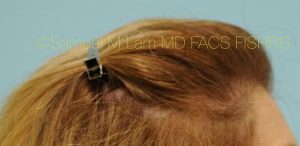 Female Hair Restoration