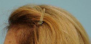 Female Hair Restoration