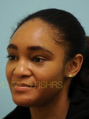 Eyebrow Hair Restoration