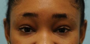 Eyebrow Hair Restoration