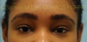 Eyebrow Hair Restoration