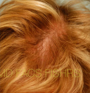 Female Hair Restoration