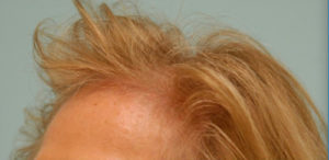 Female Hair Restoration